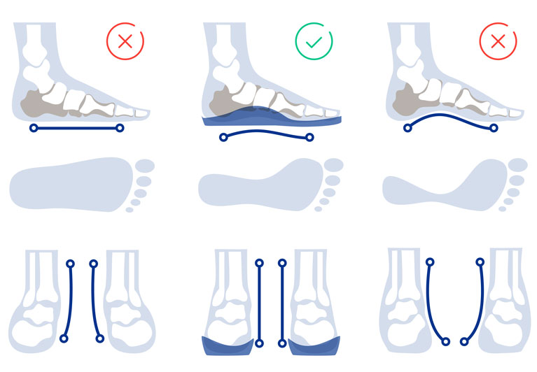 Confronto tra postura del piede con e senza supporto plantare: il plantare anatomico Birkenstock al centro favorisce corretta distribuzione del peso e allineamento.